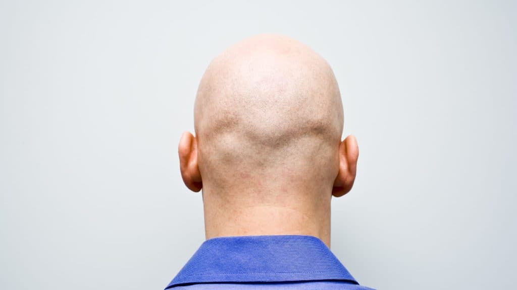 Calling A Man ‘Bald’ Is Now Considered Sexual Harassment, High Court Rules