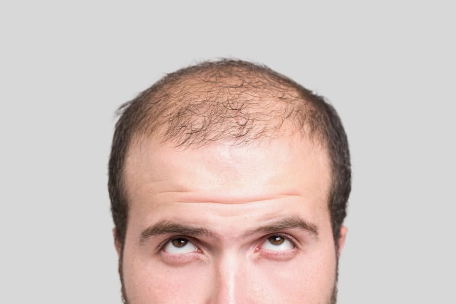 Top Hair Surgeon Warns Men Too Much Masturbation Can Cause Hair Loss