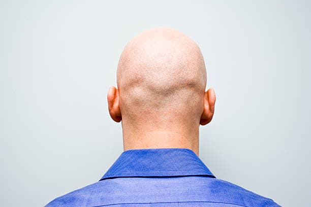 Calling A Man Bald Is Now Classed As Sexual Harassment, Employment Tribunal Rules